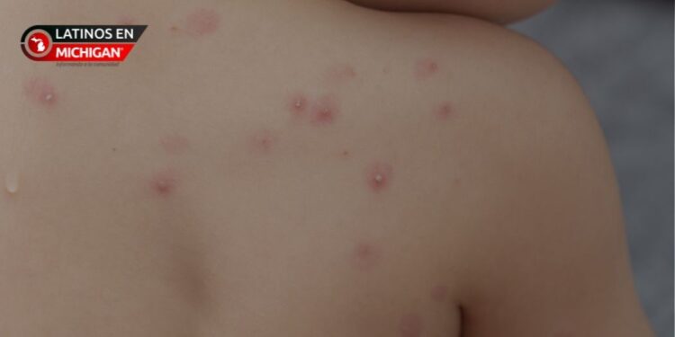 Viruela del mono en EE.UU., Esto es lo que hay que saber