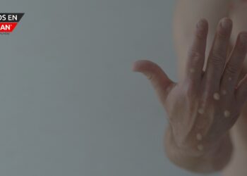 14 nuevos casos de viruela del mono en Michigan