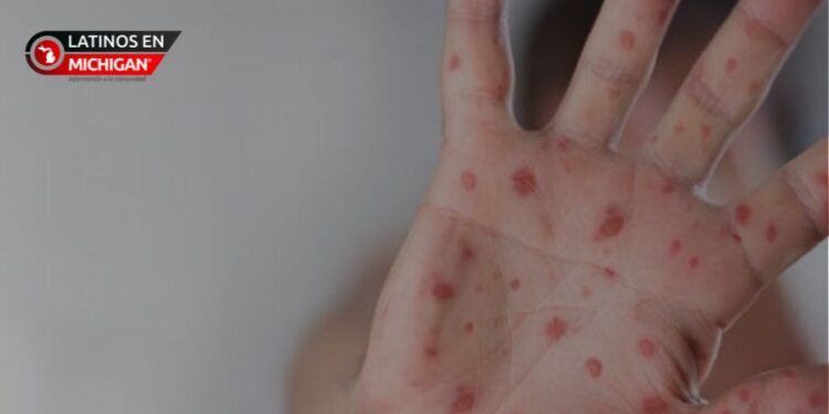 Nuevo caso de sarampión reportado en el condado de Ingham en Michigan